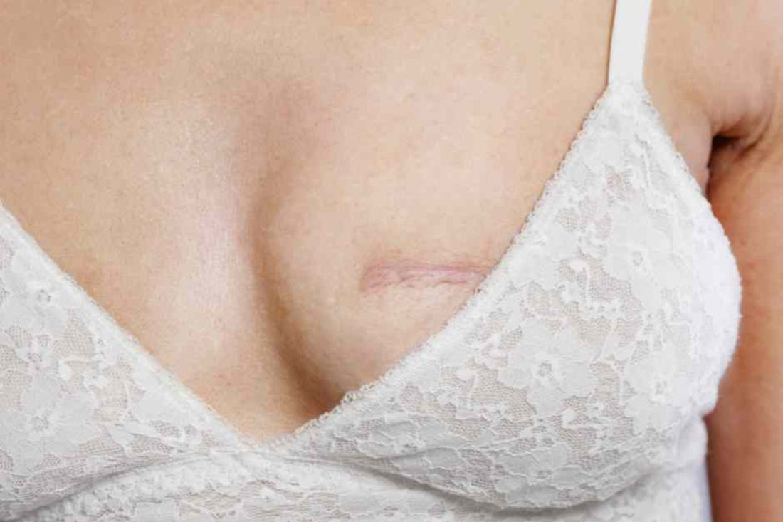 What to Wear After Lumpectomy Surgery