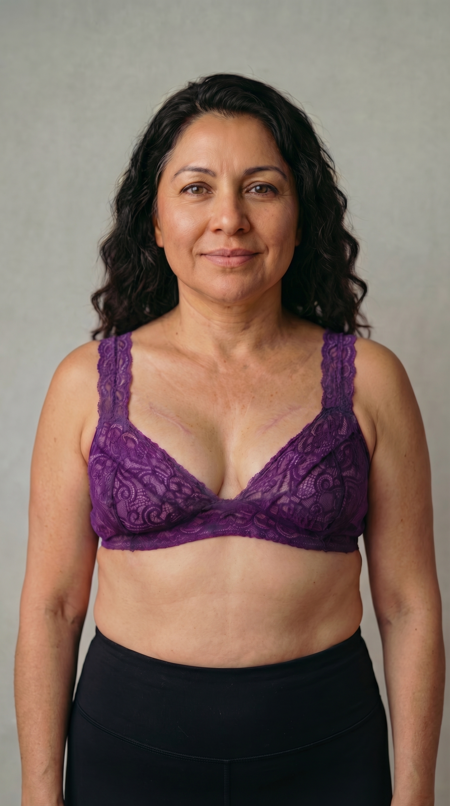Woman wearing a purple bra with a balanced silhouette after breast surgery