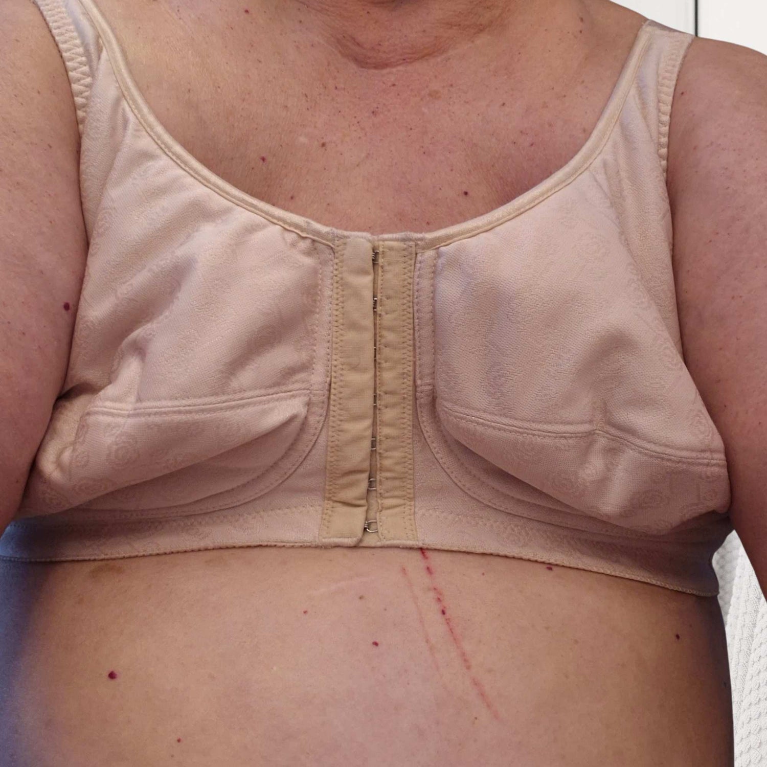 Teardrop Breast Form (Single) Post-Mastectomy